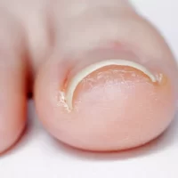 ingrown-toenails-7-1024x683